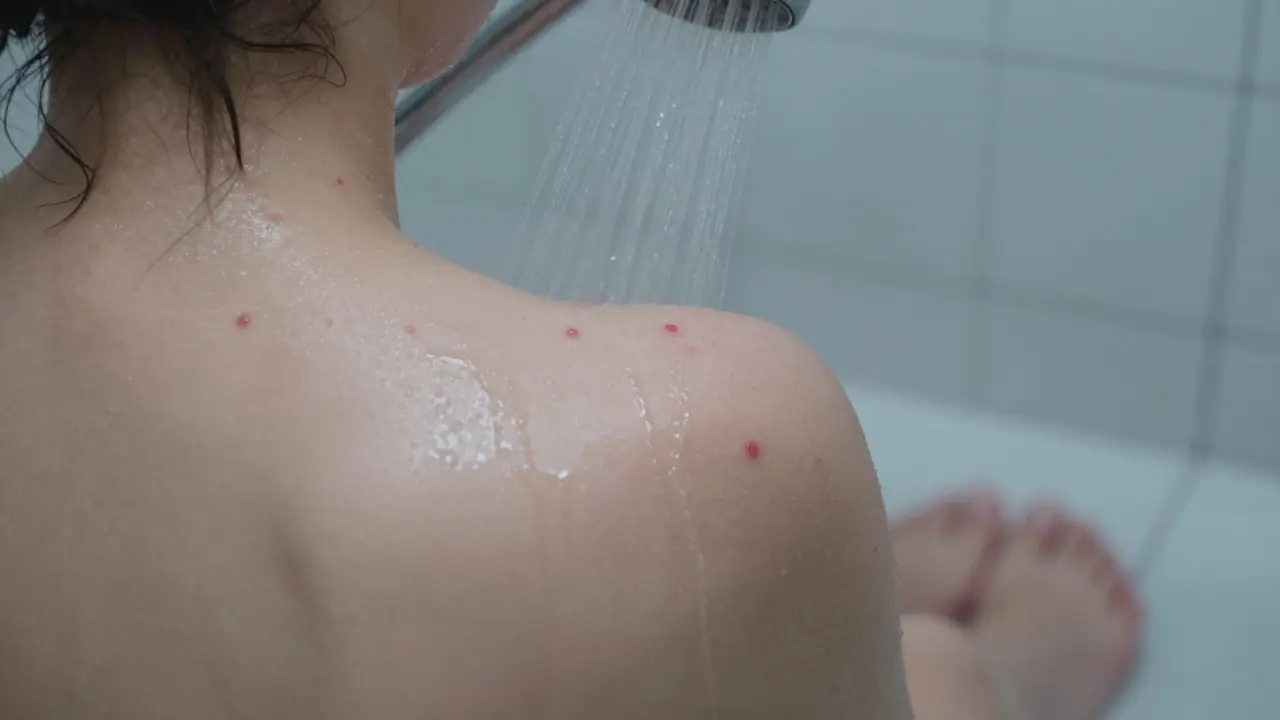 Záda s vyrážkou, oplachovaná vodou ve sprše.