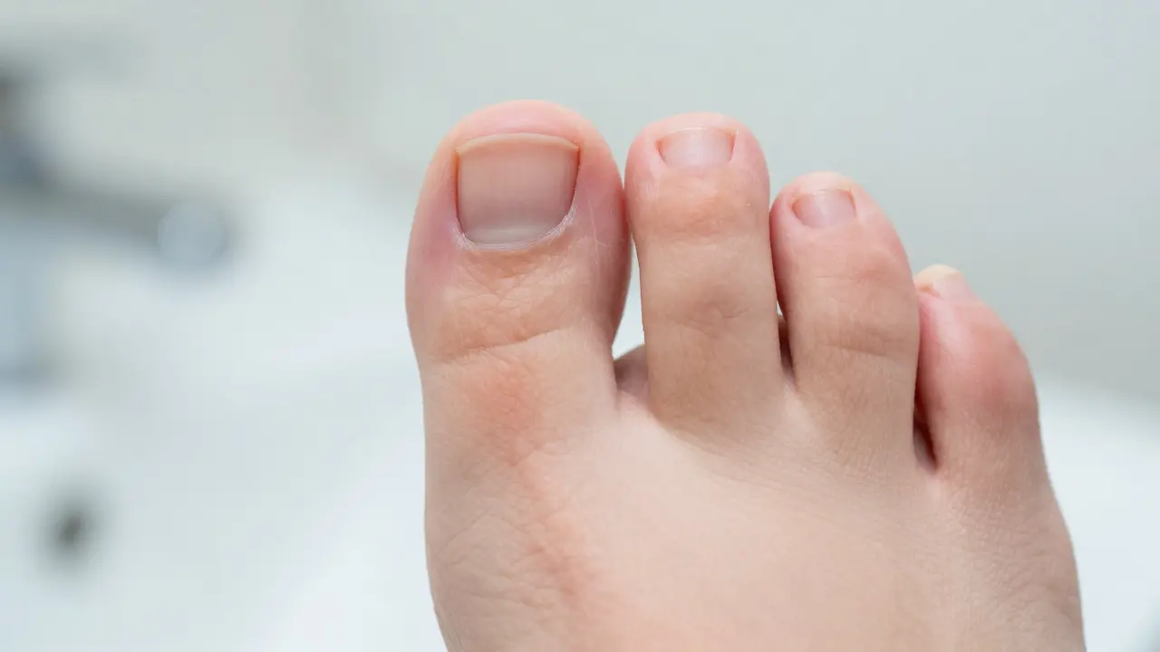 Co na zarostlý nehet? Ošetření, prevence a kdy jít k lékaři