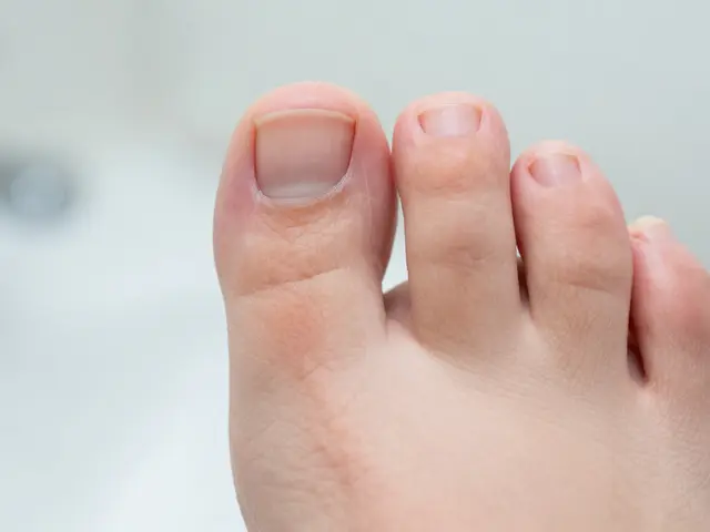 Co na zarostlý nehet? Ošetření, prevence a kdy jít k lékaři
